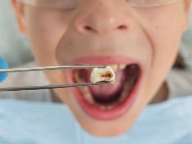 Best Dental Abscess Treatment in Rocky Top, TN